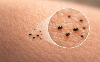 peau-humaine-creatures-noires-gros-plan